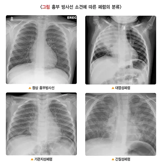폐렴 종류 설명 이미지 1