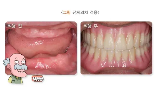 가철성 보철 치료 방법 설명 이미지 2