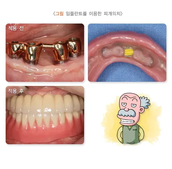 가철성 보철 치료 방법 설명 이미지 4