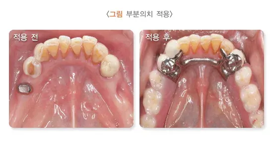 가철성 보철 치료 방법 설명 이미지 1