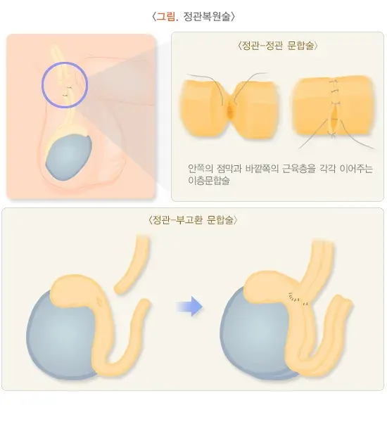 정관수술 치료 방법 설명 이미지 2