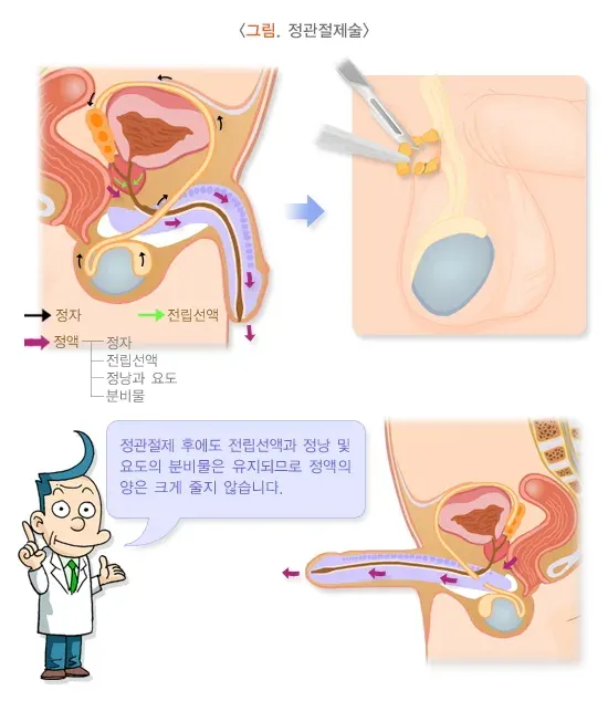 정관수술 치료 방법 설명 이미지 1