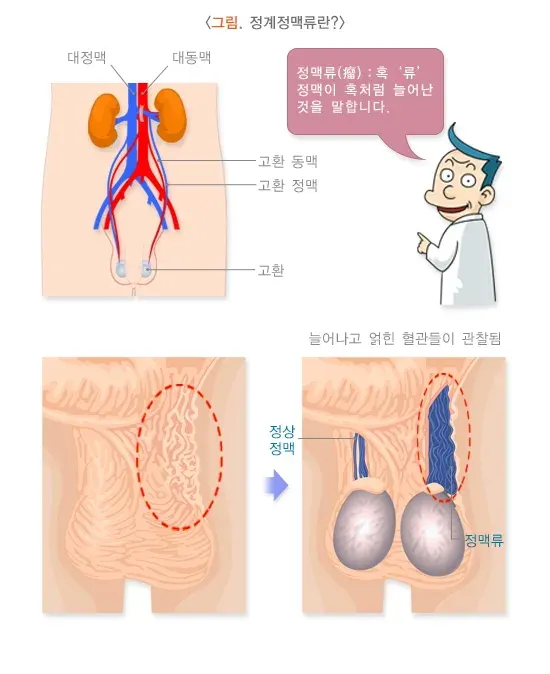 정계정맥류 정의 설명 이미지 1