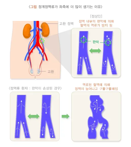 정계정맥류 원인 설명 이미지 1