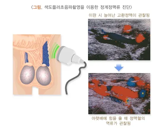 정계정맥류 진단 및 검사 설명 이미지 2