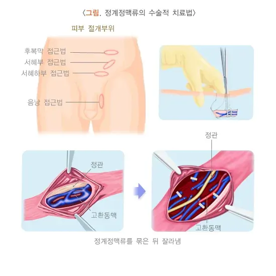 정계정맥류 비약물 치료 설명 이미지 2