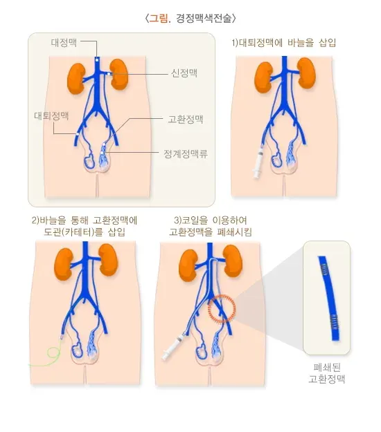 정계정맥류 비약물 치료 설명 이미지 3