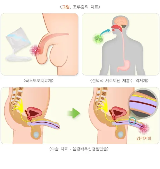 조루증 치료 설명 이미지 1