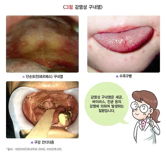 구내염 종류 설명 이미지 1
