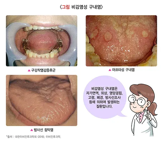 구내염 종류 설명 이미지 2