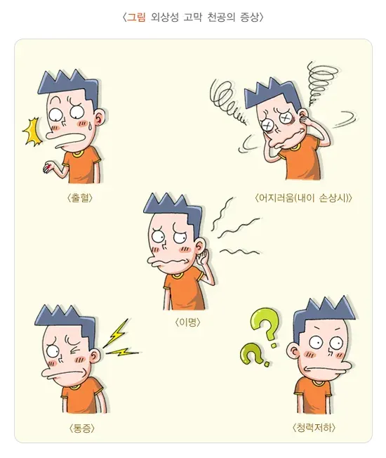 외상성 고막 천공 증상 설명 이미지 1
