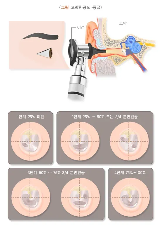 외상성 고막 천공 진단 및 검사 설명 이미지 1