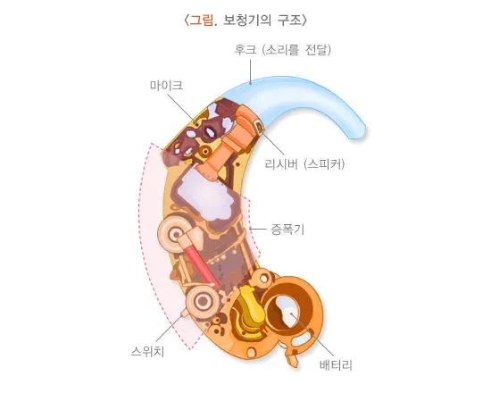 노인성난청 치료 설명 이미지 1