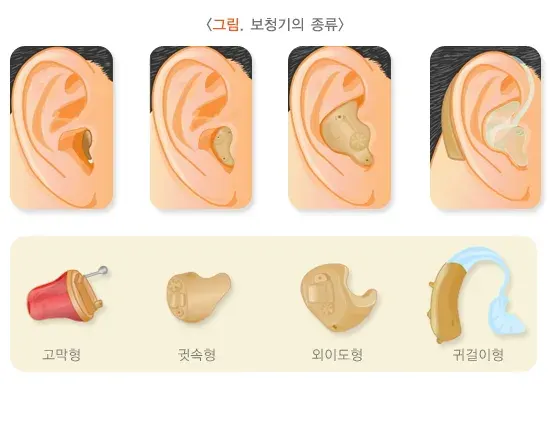 노인성난청 치료 설명 이미지 2