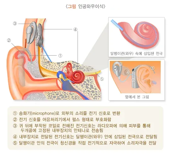 노인성난청 치료 설명 이미지 3