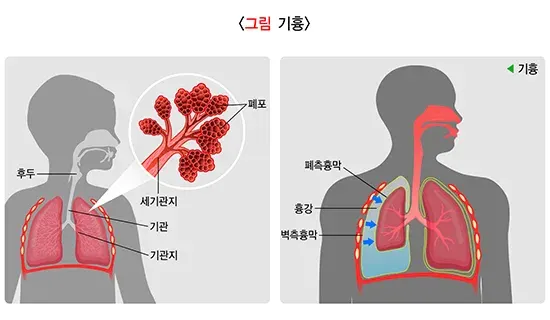 기흉 정의 설명 이미지 1