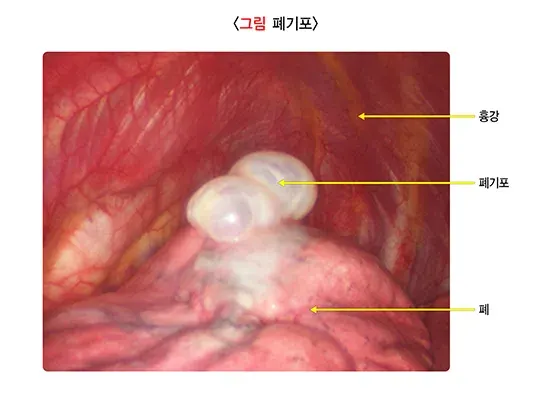 기흉 종류 설명 이미지 1