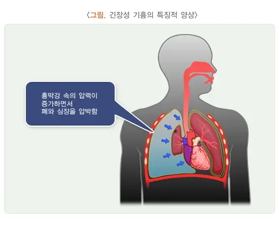 기흉 종류 설명 이미지 3