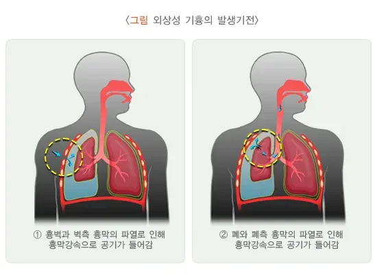 기흉 종류 설명 이미지 2