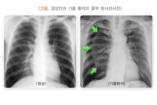 기흉 진단 및 검사 설명 이미지 1