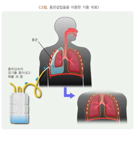 기흉 치료 설명 이미지 1