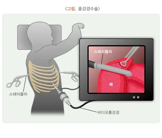 기흉 치료 설명 이미지 2