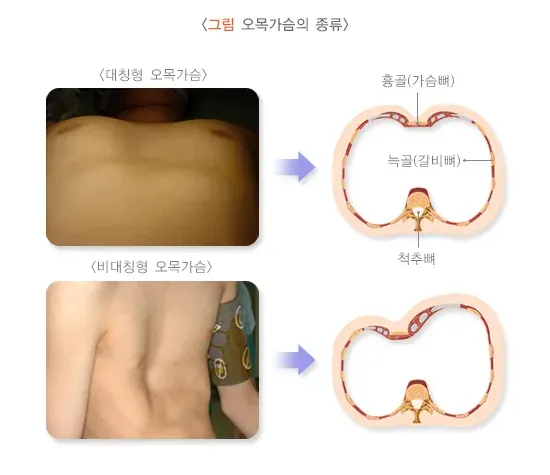 흉곽기형(오목가슴, 함몰흉, 누두흉) 종류 설명 이미지 1