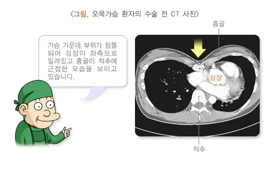 흉곽기형(오목가슴, 함몰흉, 누두흉) 진단 및 검사 설명 이미지 1