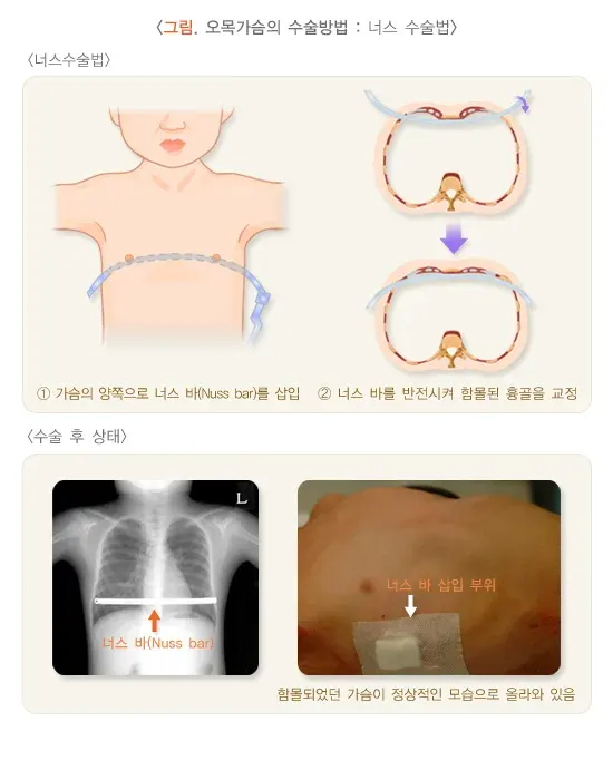 흉곽기형(오목가슴, 함몰흉, 누두흉) 치료 설명 이미지 1