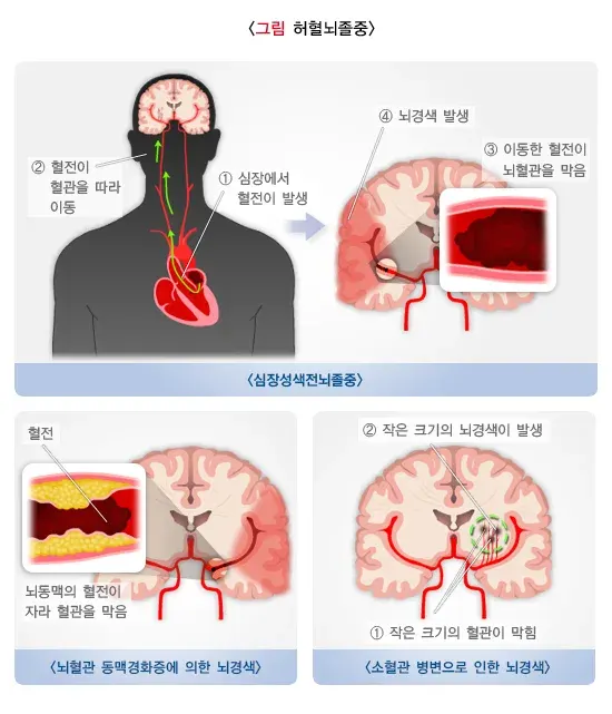 뇌졸중 원인 설명 이미지 1