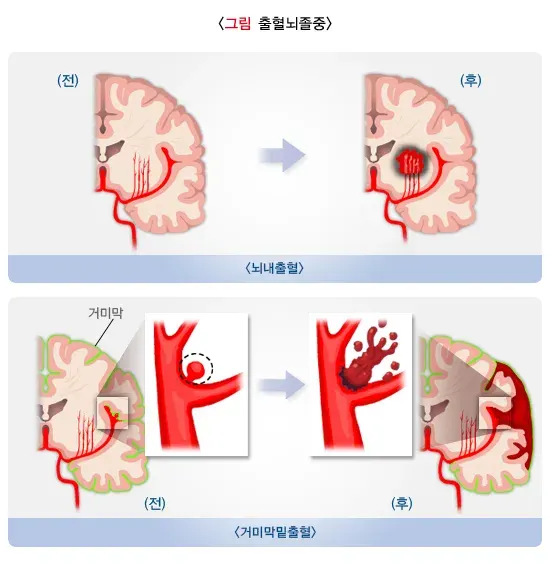 뇌졸중 원인 설명 이미지 2