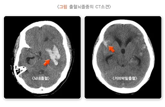 뇌졸중 진단 및 검사 설명 이미지 1