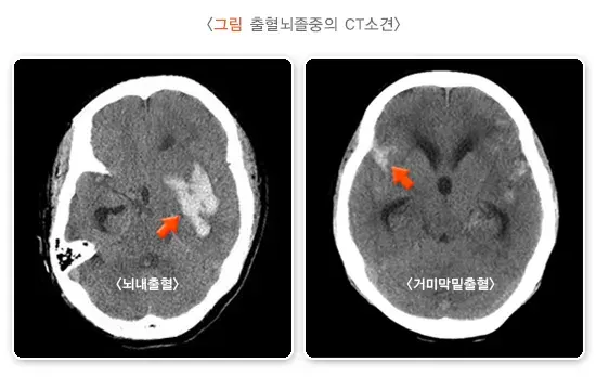 뇌졸중 진단 및 검사 설명 이미지 1