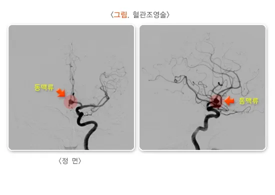 뇌졸중 진단 및 검사 설명 이미지 3