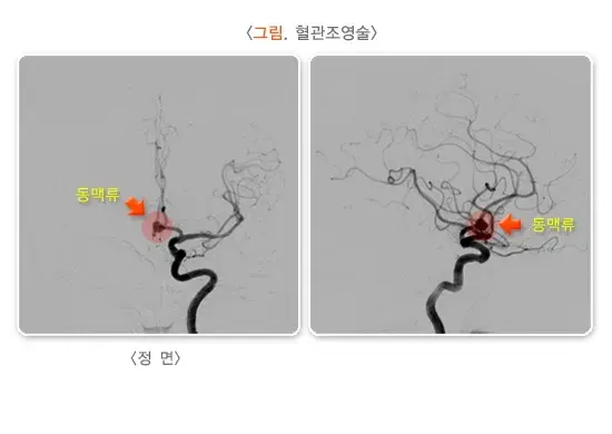 뇌졸중 진단 및 검사 설명 이미지 3