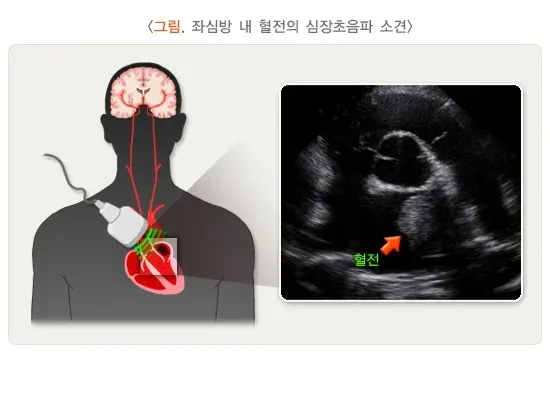 뇌졸중 진단 및 검사 설명 이미지 4