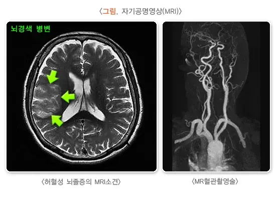 뇌졸중 진단 및 검사 설명 이미지 2