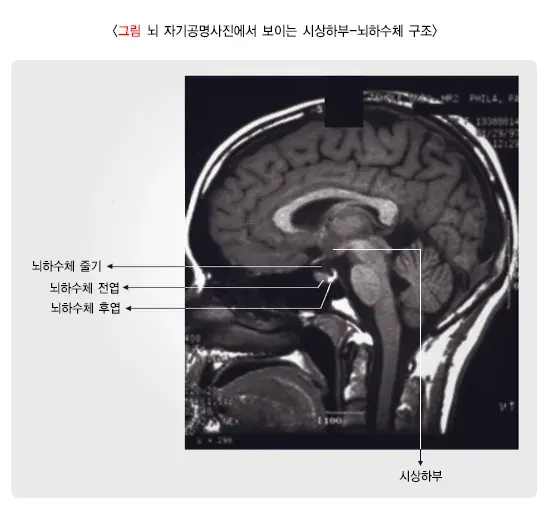 뇌하수체기능저하증(소아) 정의 설명 이미지 1