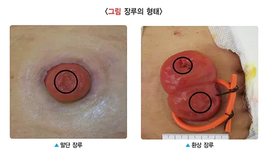 장루 및 장루 관리 중요성 설명 이미지 1