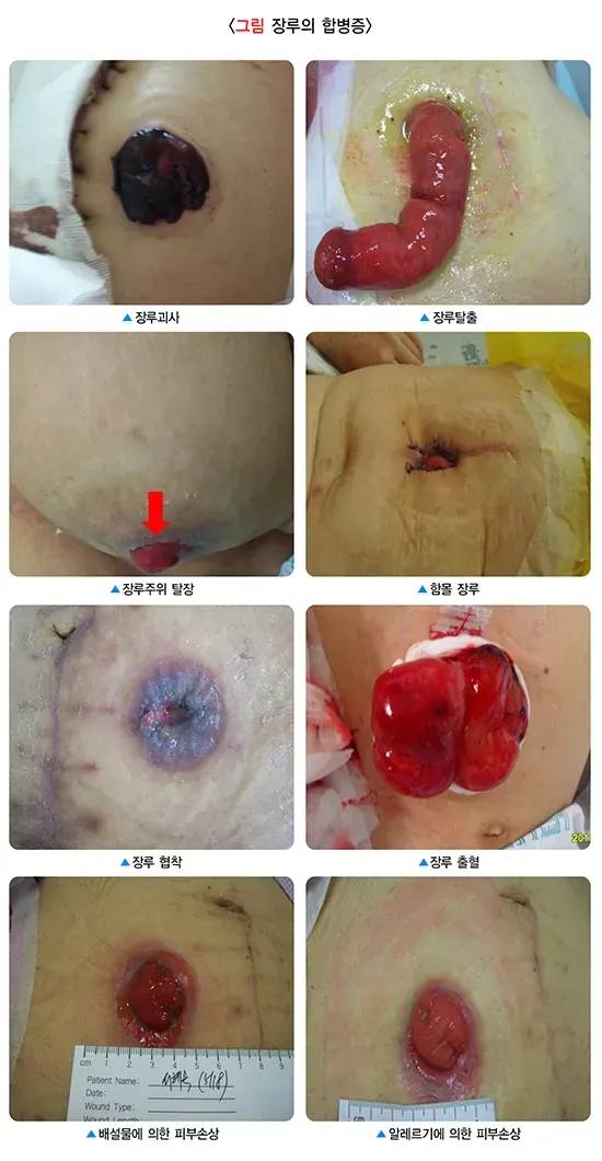 장루 및 장루 관리 관련 증상 및 질환 설명 이미지 1