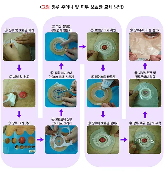 장루 및 장루 관리 증상 자가 관리 방법 설명 이미지 1