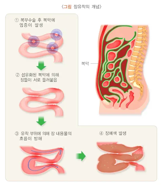 복부 수술 후 장유착 원인 설명 이미지 1