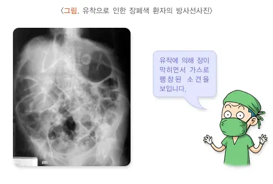 복부 수술 후 장유착 진단 및 검사 설명 이미지 1