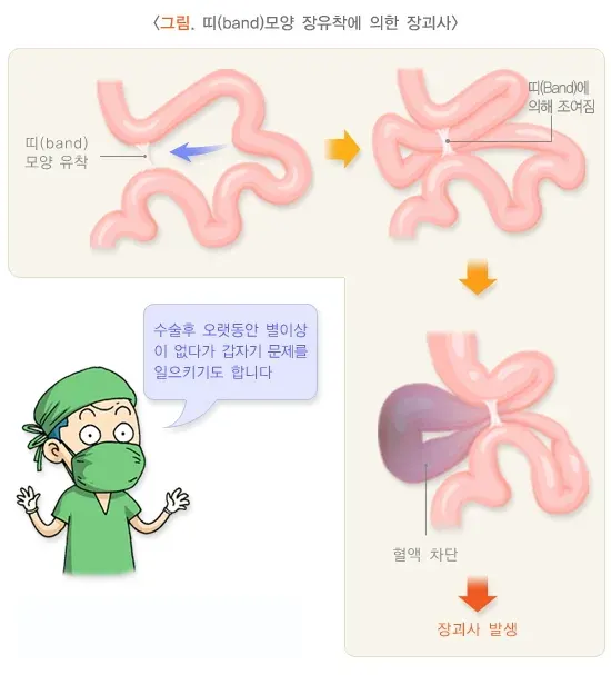 복부 수술 후 장유착 합병증 설명 이미지 1
