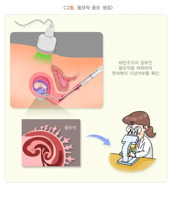 융모막 융모 검사 검사 검체 설명 이미지 1