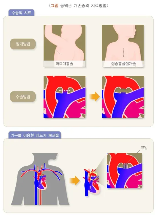 동맥관 개존증 치료 설명 이미지 1