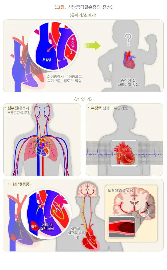 심방중격결손증 증상 설명 이미지 1