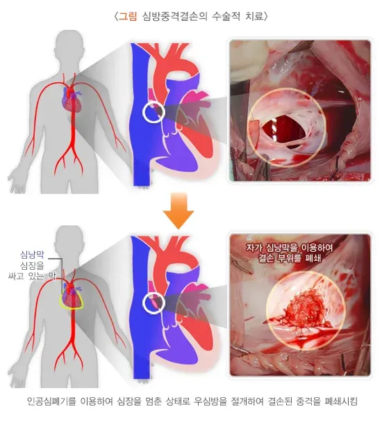 심방중격결손증 치료 설명 이미지 2