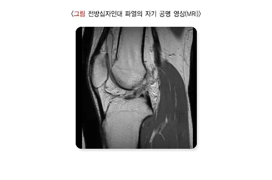 무릎 인대 손상 진단 및 검사 설명 이미지 1