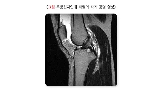 무릎 인대 손상 진단 및 검사 설명 이미지 2